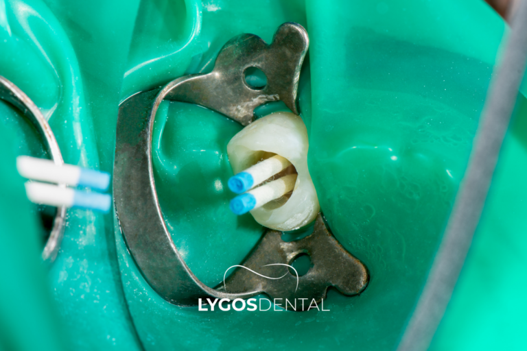 In cosa consiste effettivamente una devitalizzazione