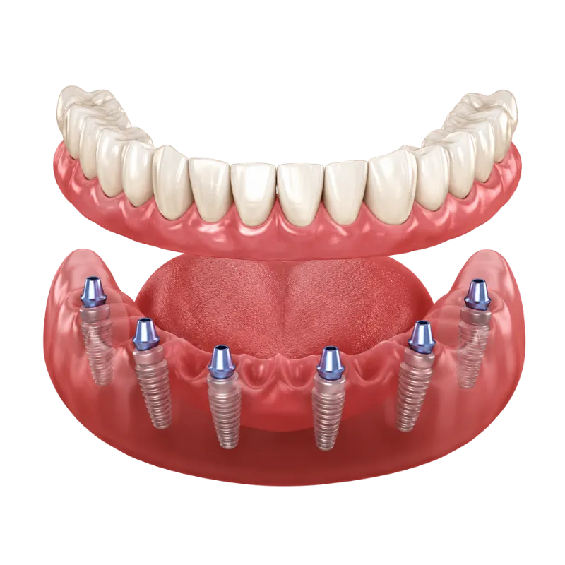 All-on-6 Full Arch