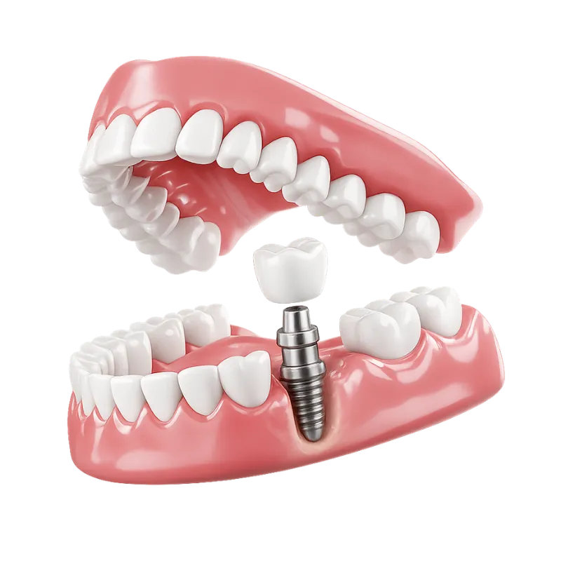 Single Dental Implant