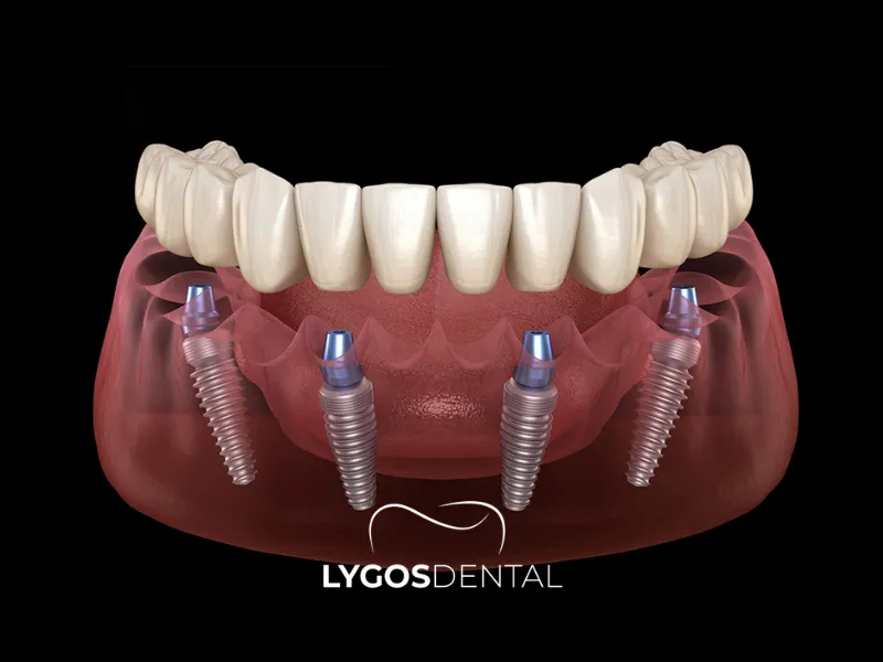 Impianti dentali All-on-4