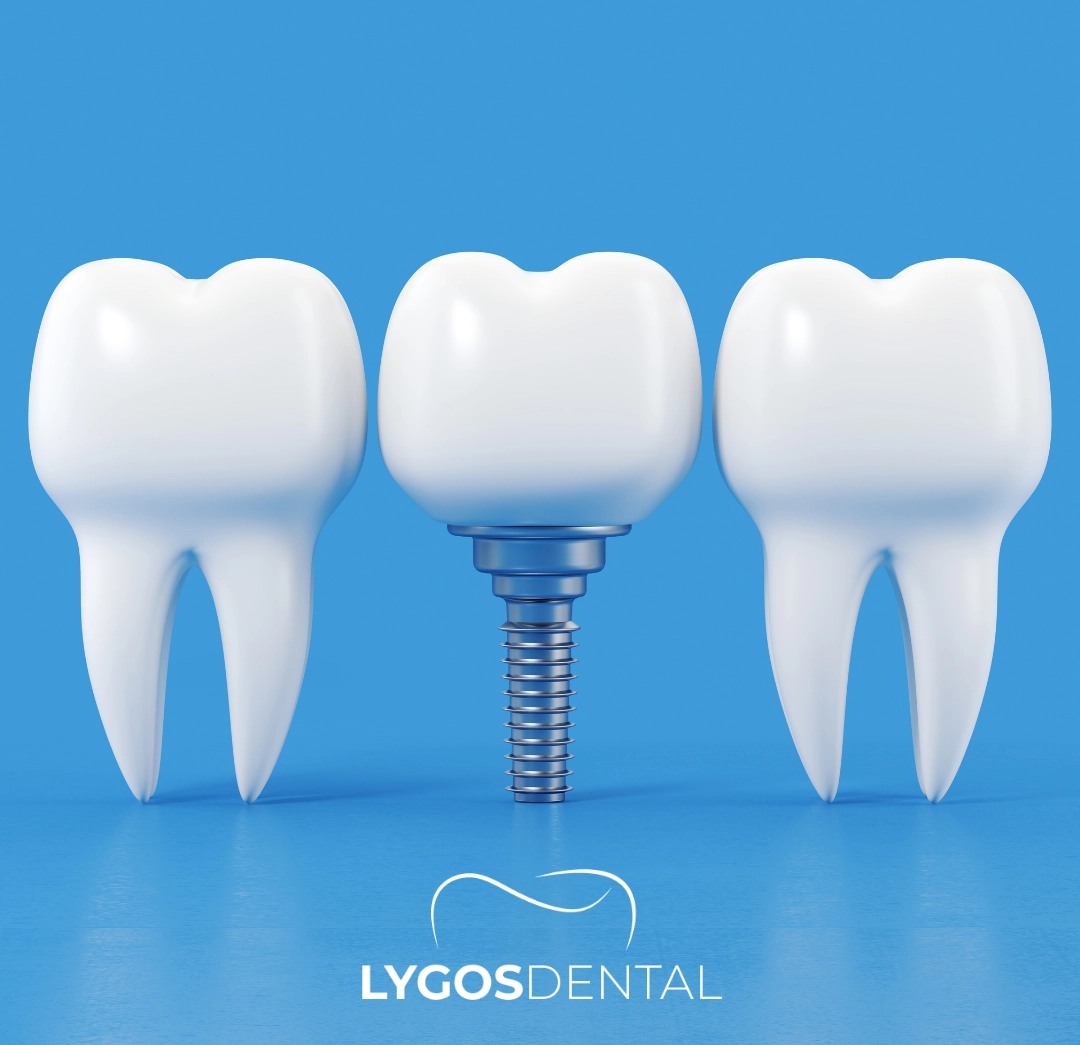 Stages of All-on-4 Dental Implants Treatment