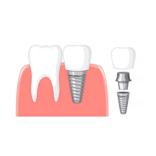 Dental Implant Gnrl