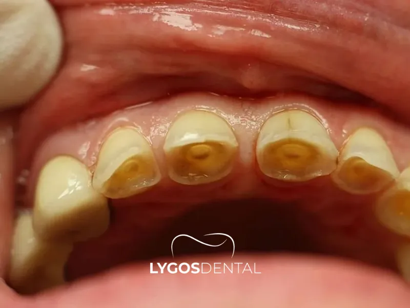 Erosione dentale | LYGS DENTAL