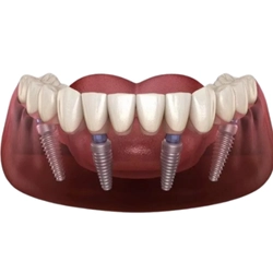 Full Mouth Implant Main