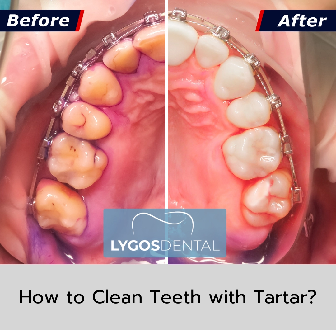 How to Clean Teeth with Tartar?