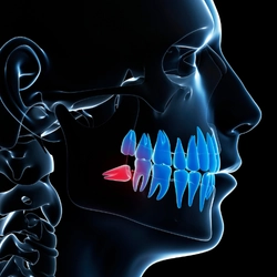 wisdom-tooth-extraction-main