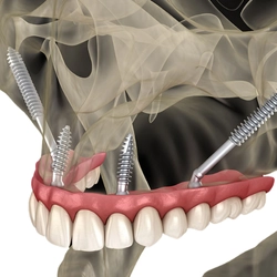 zygomatic-implant-main