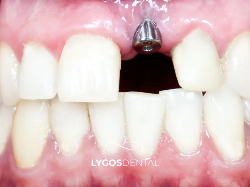Impianto dentale per denti anteriori | LYGOS DENTAL