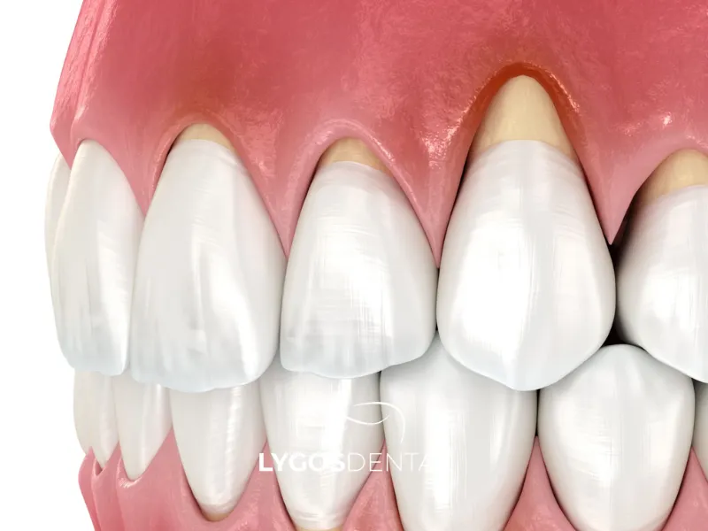 Récession gingivale | LYGOS DENTAL