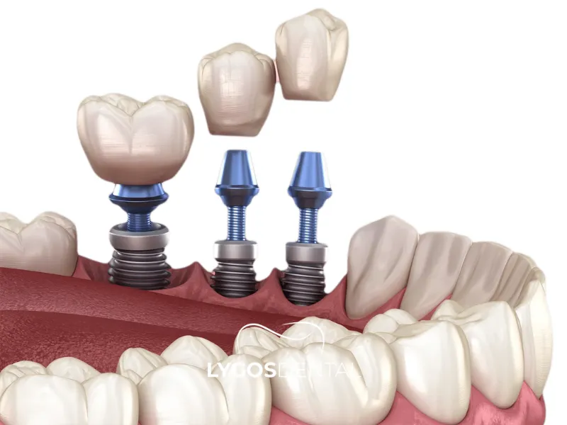 Trattamento con mini-impianti dentali | LYGOS DENTAL