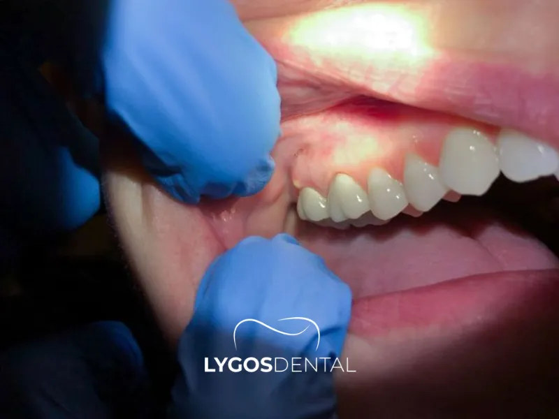 Cause dell’ascesso dentale – Ascesso dentale – LYGOS DENTAL