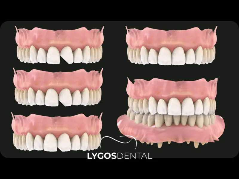 Rimodellamento dentale | LYGOS DENTAL
