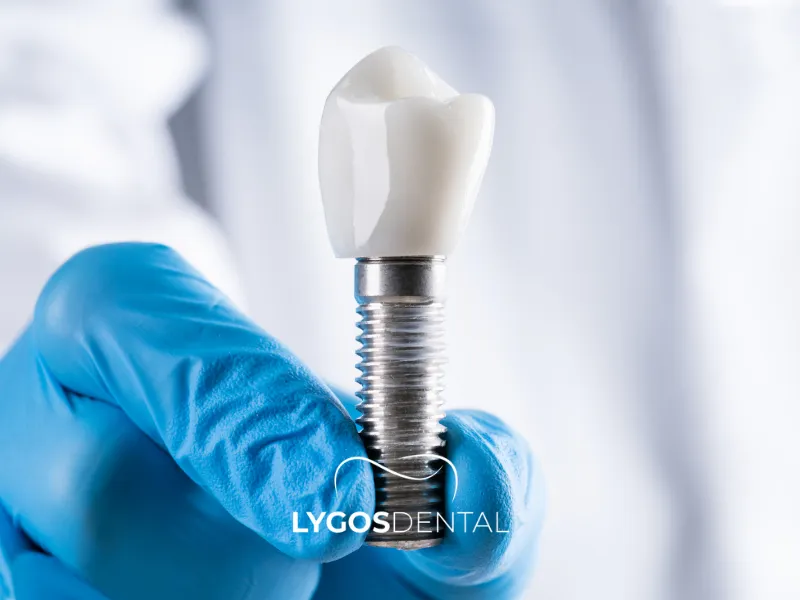 Tipi di impianti dentali | LYGOS DENTAL