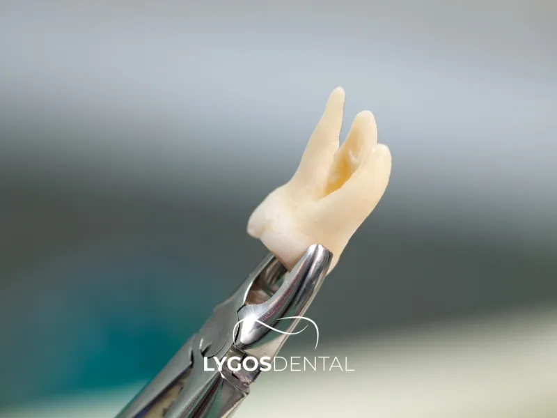 Che cos’è l’estrazione dentale? | LYGOS DENTAL