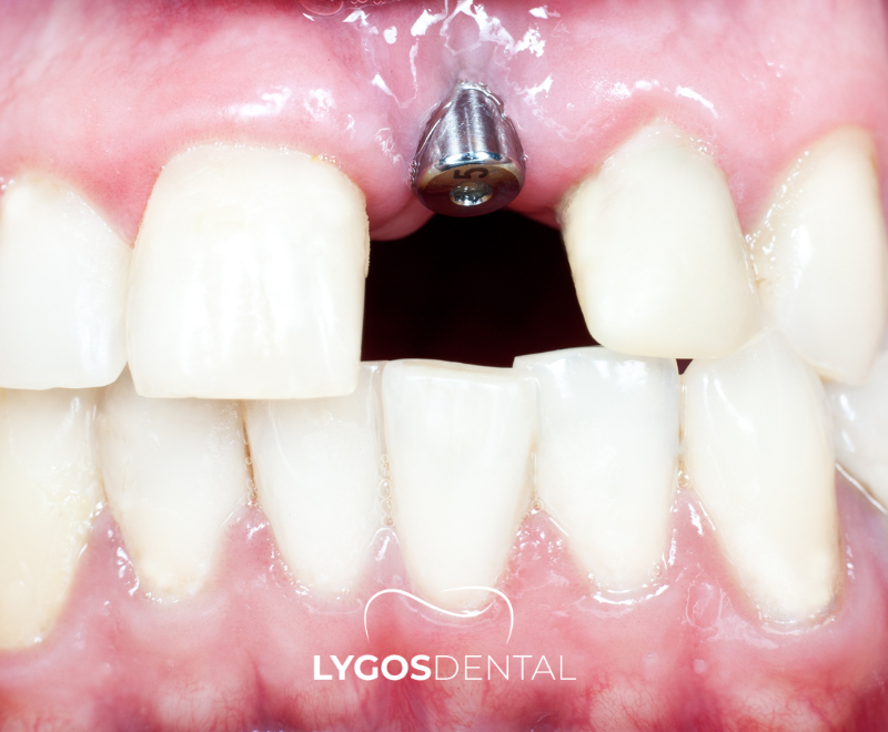 Dental Implant Front Tooth | LYGOS DENTAL 2024