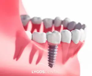 Diş İmplantı Çeşitleri | LYGOS DENTAL 2024