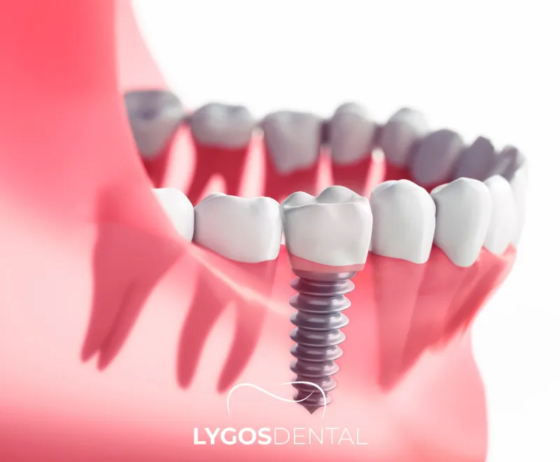 Diş İmplantı Çeşitleri | LYGOS DENTAL 2024