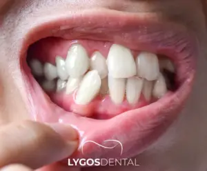 Diş Şekillendirme | LYG DENTAL 2024