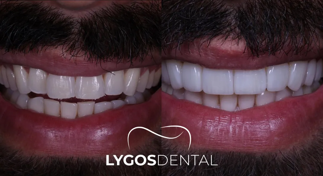 Emax Veneers Before and After