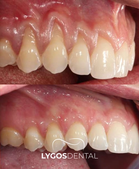 Gum Graft HomePage