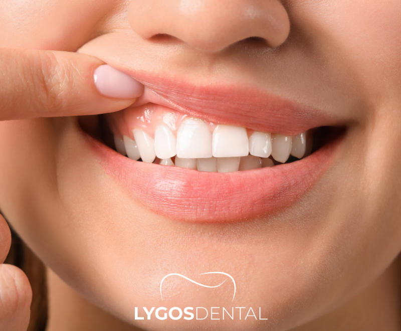 Gum Recession | LYGOS DENTAL 2024