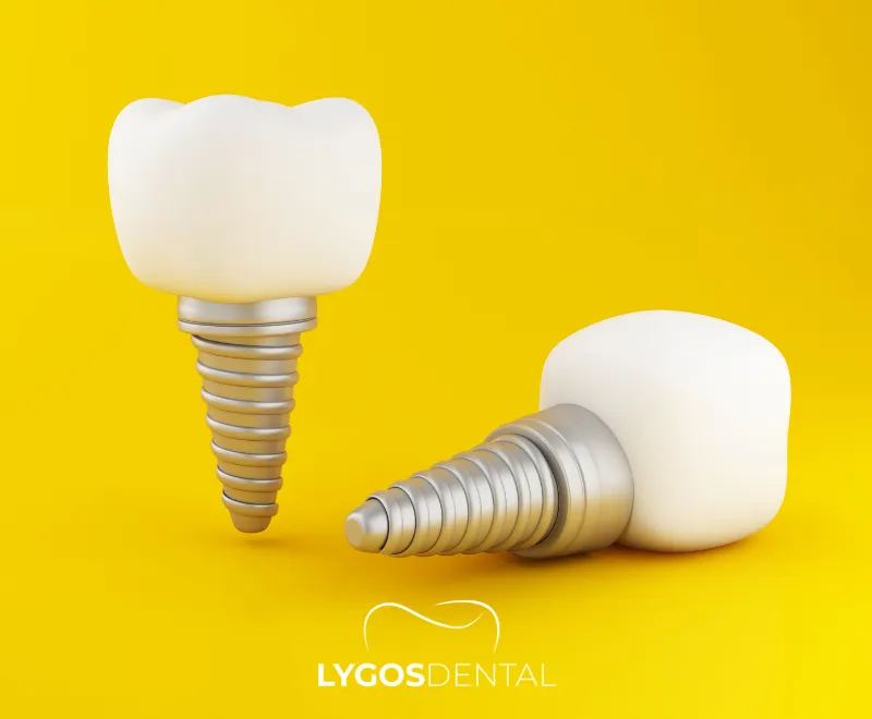 Mini Dental İmplant Tedavisi | LYGOS DENTAL 2024