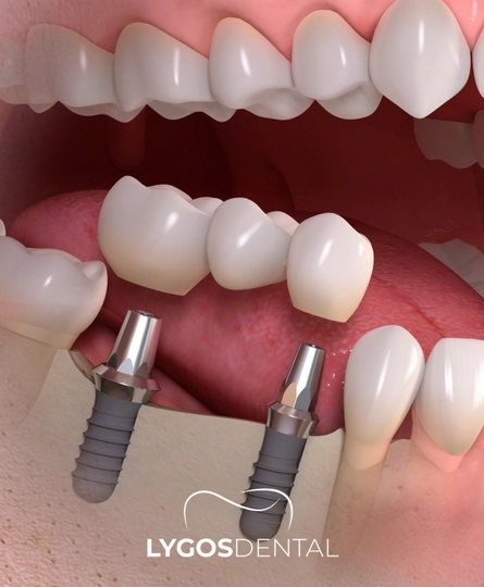 Multiple Dental Implant HomePage