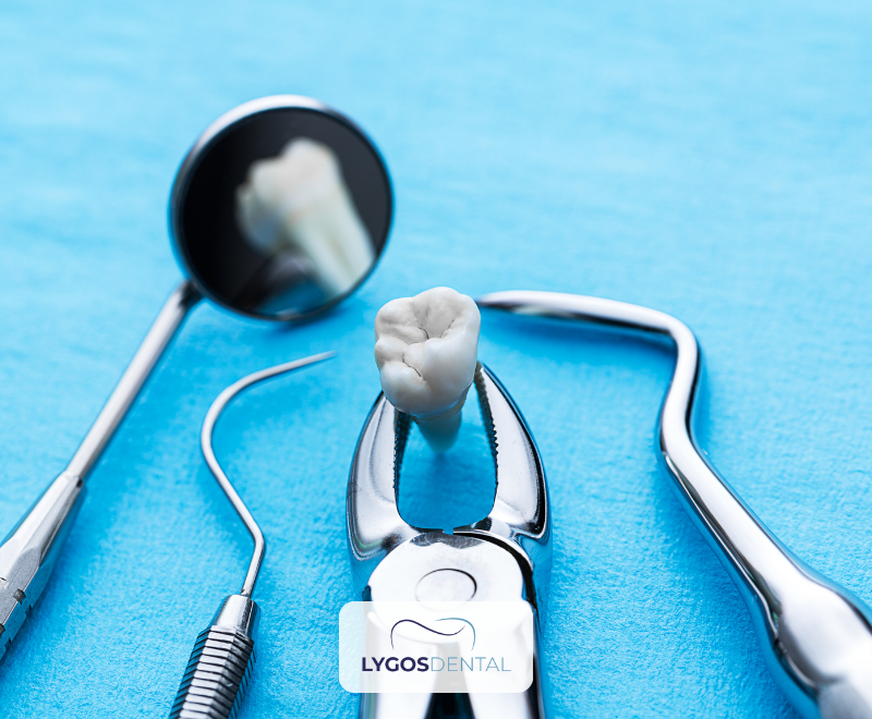 What is Tooth Extraction? | LYGOS DENTAL 2024