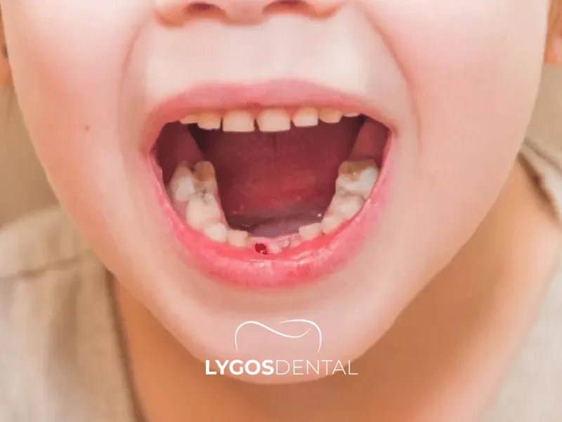 Bleeding Gums in Children | LYGOS DENTAL
