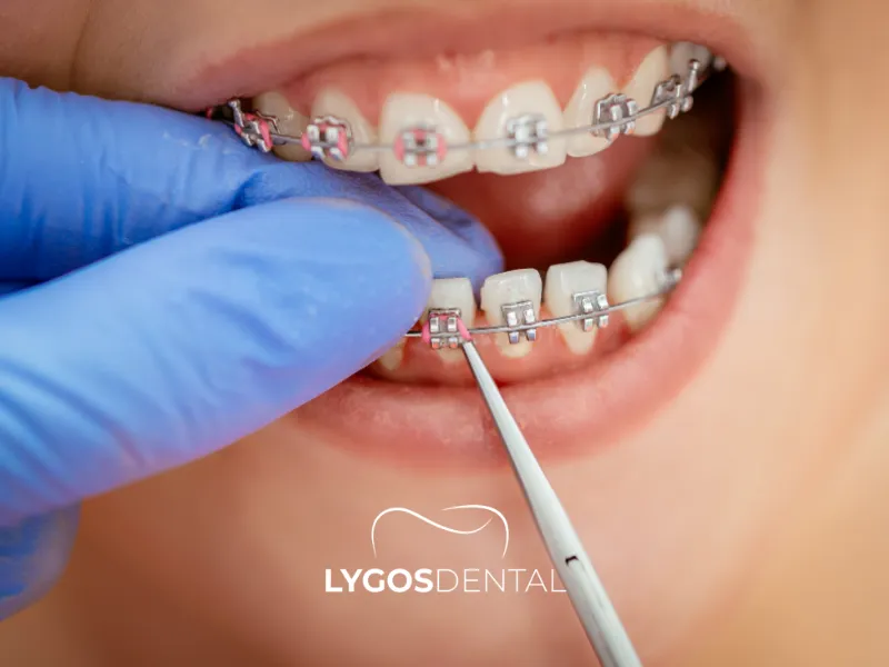 La dentizione nei neonati | LYGOS DENTAL