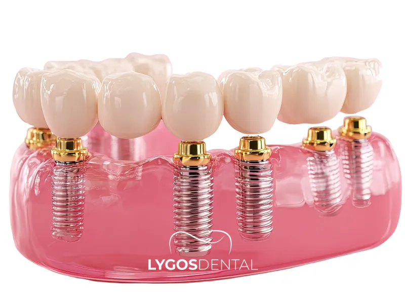 Prezzi dei pacchetti per impianti dentali completi in Turchia