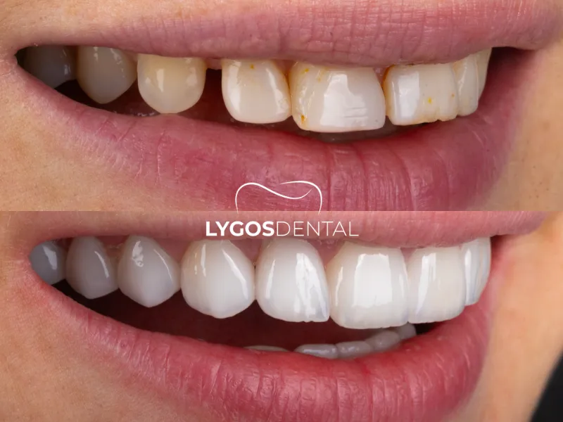 Faccette in laminato in Turchia | LYGOS DENTAL