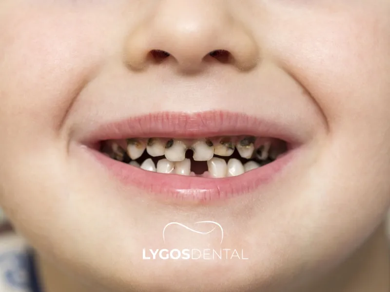Carie nei bambini | LYGOS DENTAL