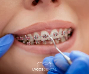 Traitement orthodontique | LYGOS DENTAL