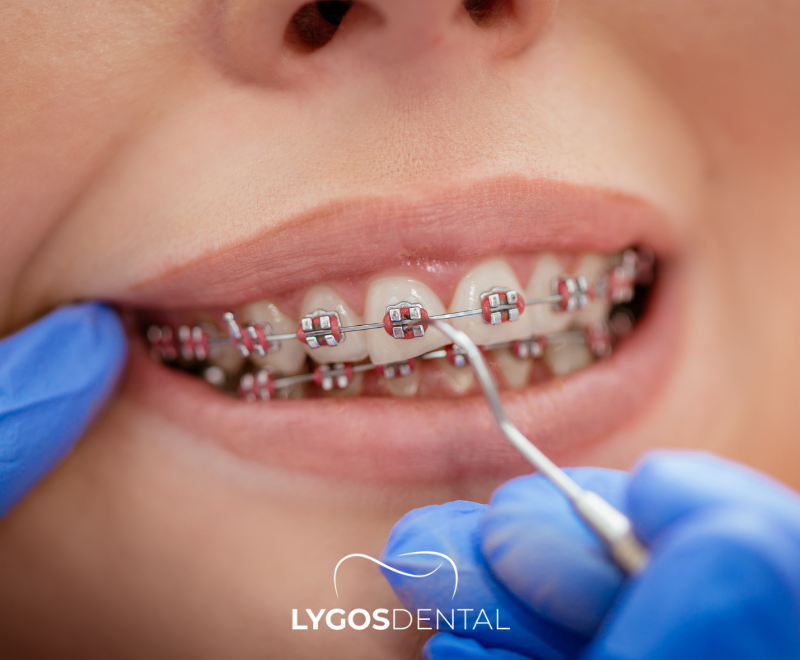 Braces Treatment | LYGOS DENTAL 2024