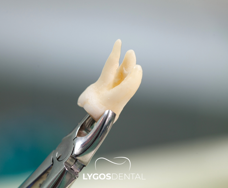 Horizontal Impacted Wisdom Tooth | LYGOS DENTAL 2025