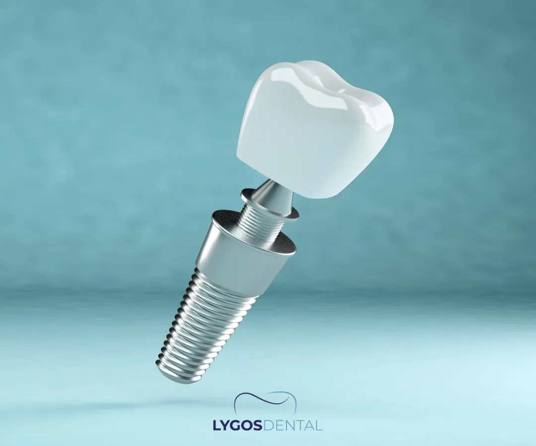 When is the Best Time to Start the Dental Implant Process