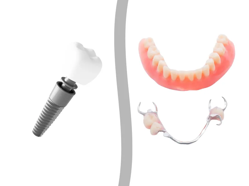 È meglio ricorrere agli impianti dentali o alle protesi dentarie? | LYGOS DENTAL