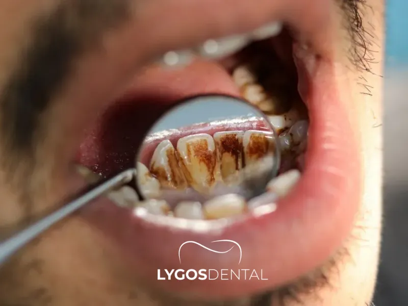 How to Remove Coffee Stains on Teeth | LYGOS DENTAL