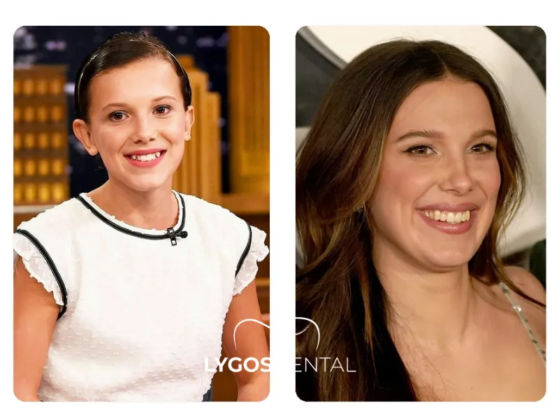 Millie Bobby Brown tandfacings | LYGOS DENTAL
