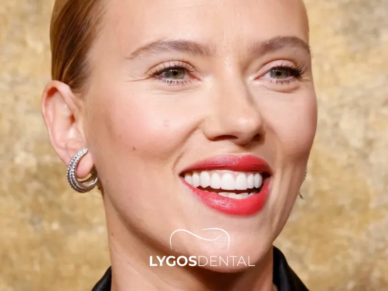 Faccette Dentali Di Scarlett Johansson | LYGOS DENTAL