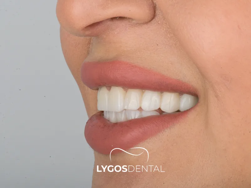 Progettazione del sorriso | LYGOS DENTAL