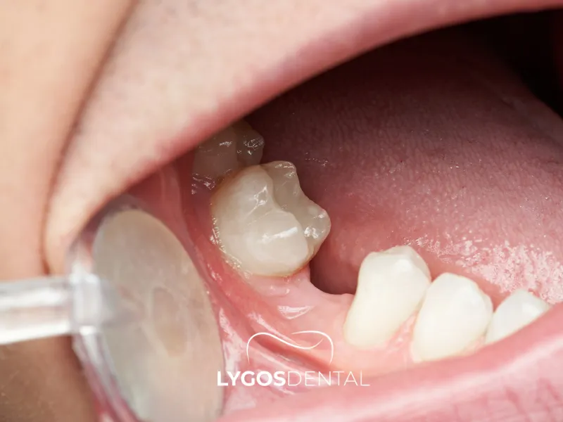 O que acontece se engolir um dente | LYGOS DENTAL