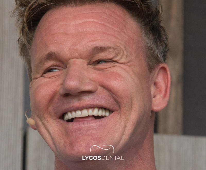 Gordon Ramsay Teeth Veneers | LYGOS DENTAL 2025