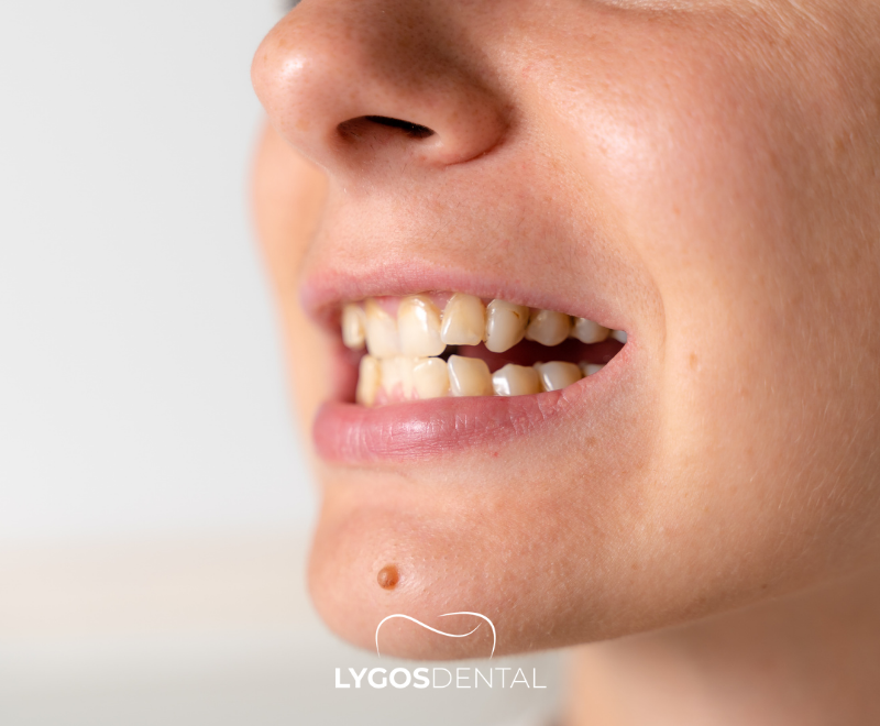 How to Remove Coffee Stains on Teeth | LYGOS DENTAL 2025