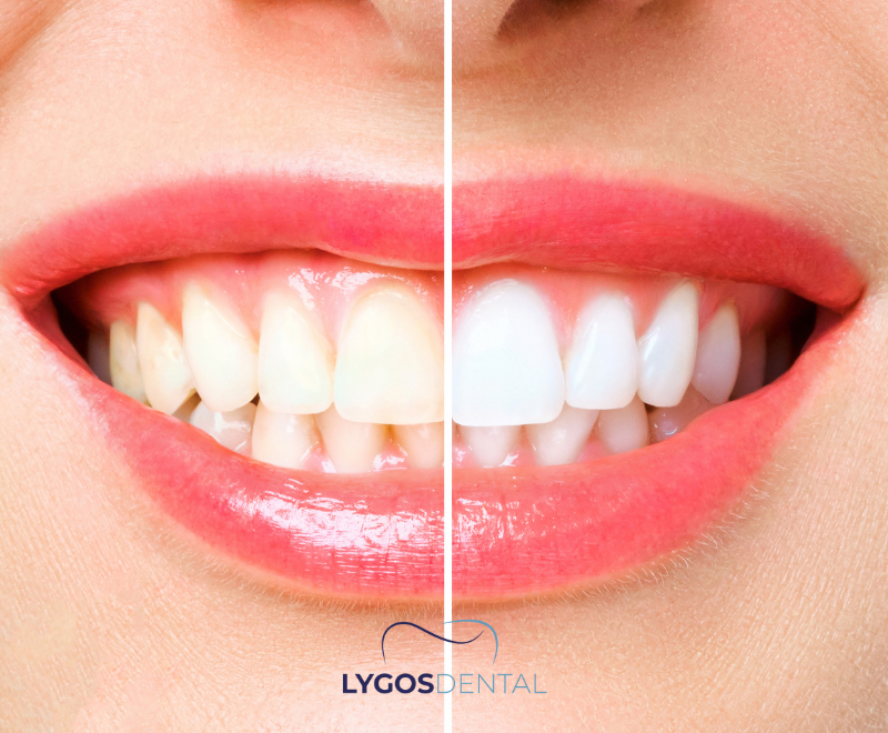 Side Effects of Teeth Whitening Products | LYGOS DENTAL 2025