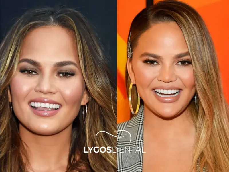 Chrissy Teigen Esthétique dentaire | LYGOS DENTAL