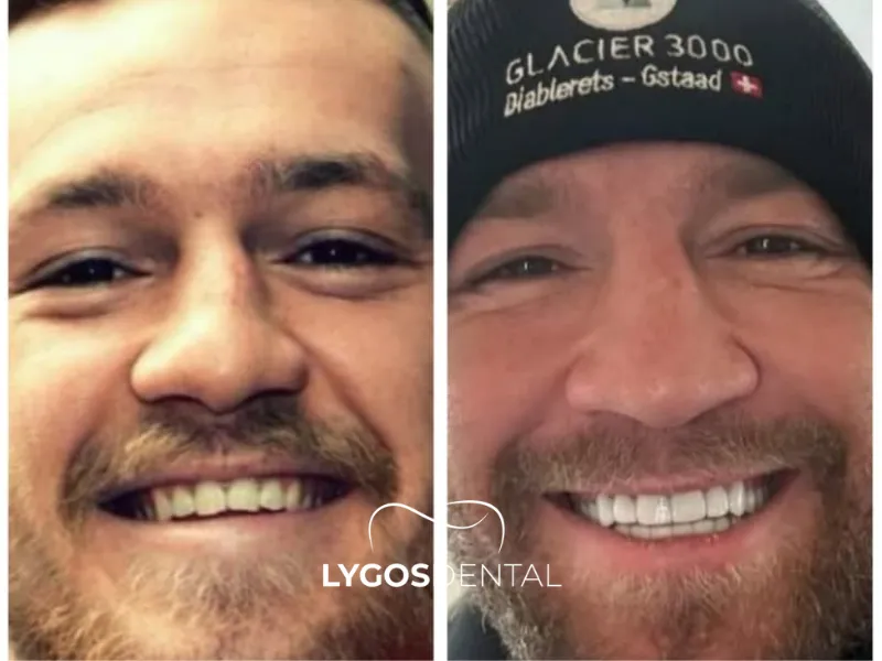 Faccette dentali per Conor McGregor | LYGOS DENTAL