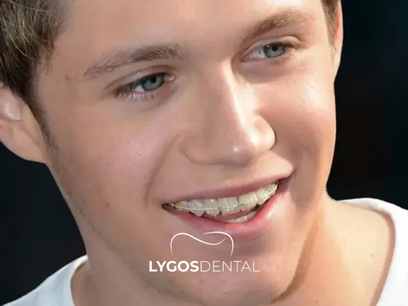 Estetica dentale Niall Horan | LYGOS DENTAL