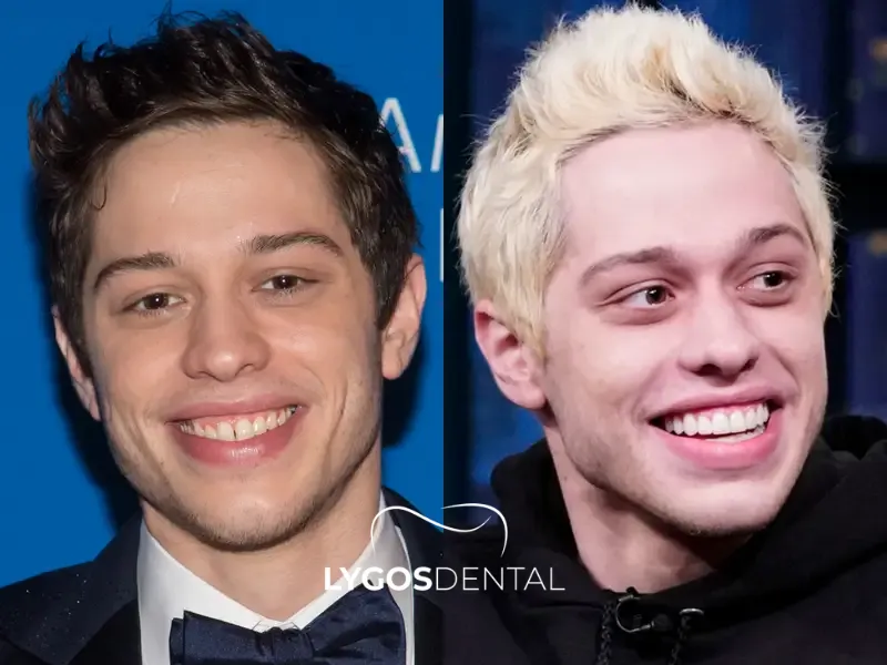 Faccette dentali di Pete Davidson | LYGOS DENTAL